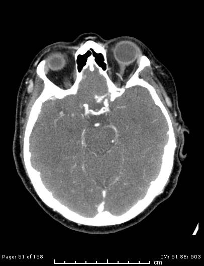 Cerebellar strokes due to intracranial giant cell arteritis (Radiopaedia 68799-78510 CT angiogram 51).jpg