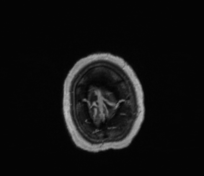Cerebellopontine angle meningioma (Radiopaedia 35181-36715 Axial T1 C+ 6).jpg