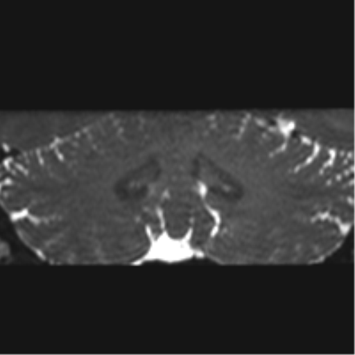 Cerebellopontine angle meningioma (Radiopaedia 48434-53348 Coronal T2 17).png