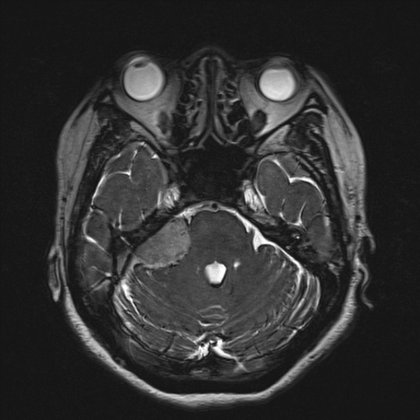 File:Cerebellopontine angle meningioma (Radiopaedia 53561-59591 Axial 3D volume T2 69).jpg