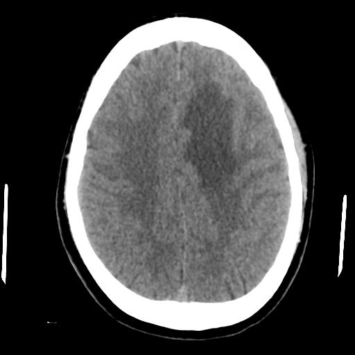 Cerebral abscess (Radiopaedia 29451-29919 Axial non-contrast 36).jpg
