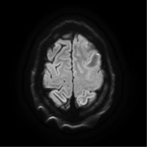 Cerebral abscess (Radiopaedia 57774-64740 Axial DWI 25).png
