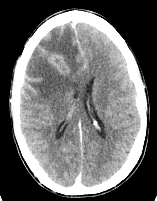 Cerebral abscess (Radiopaedia 60342-68008 Axial C+ delayed 31).png