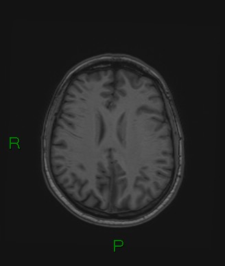 Cerebral abscess and subdural empyema (Radiopaedia 84436-99779 Axial T1 33).jpg