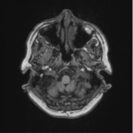 File:Cerebral abscess from pulmonary arteriovenous malformation (Radiopaedia 86275-102291 Axial T1 12).png