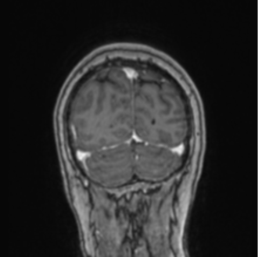 File:Cerebral abscess from pulmonary arteriovenous malformation (Radiopaedia 86275-102291 L 18).png