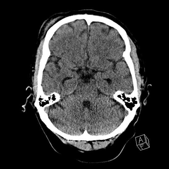 Cerebral abscess with ventriculitis (Radiopaedia 78965-91876 Axial non-contrast 18).jpg