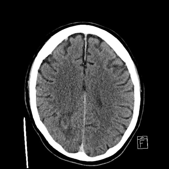 File:Cerebral abscess with ventriculitis (Radiopaedia 78965-91877 A 31).jpg