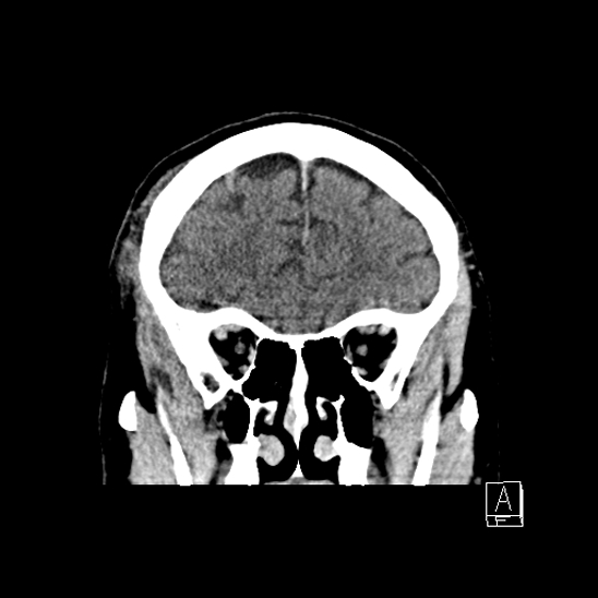 File:Cerebral abscess with ventriculitis (Radiopaedia 78965-91877 B 14).jpg