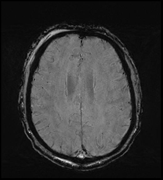 Cerebral abscess with ventriculitis (Radiopaedia 78965-91878 Axial SWI 36).jpg