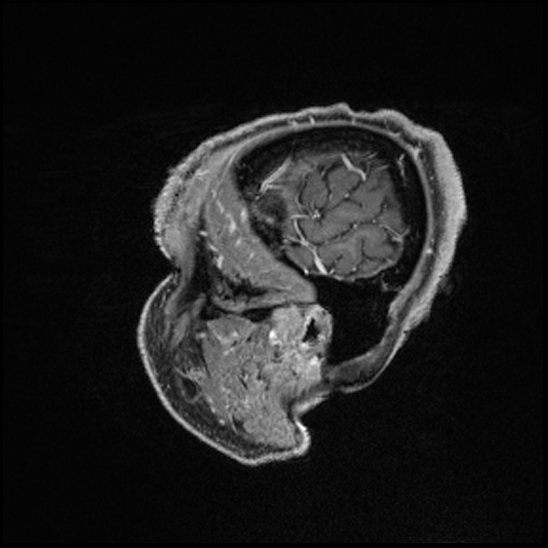 Cerebral abscess with ventriculitis (Radiopaedia 78965-91878 Sagittal T1 C+ 22).jpg