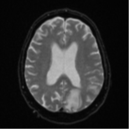 Cerebral abscesses- medically managed (Radiopaedia 45183-49179 Axial DWI 18).png