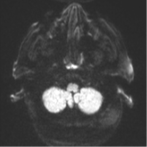 Cerebral abscesses- medically managed (Radiopaedia 45183-49179 Axial DWI 33).png