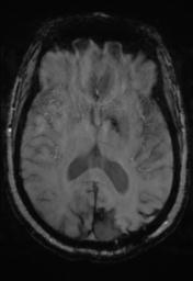 File:Cerebral amyloid angiopathy (Radiopaedia 29129-29518 Axial SWI Magnitude 19).jpg