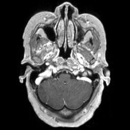 File:Cerebral amyloid angiopathy (Radiopaedia 29129-29518 Axial T1 C+ 29).jpg