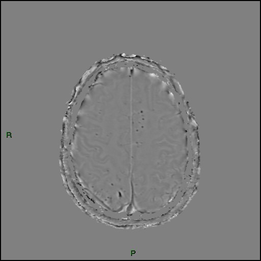 Cerebral amyloid angiopathy (Radiopaedia 77506-89664 H 80).jpg