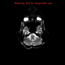 File:Cerebral and orbital tuberculomas (Radiopaedia 13308-13311 Axial DWI 24).jpg