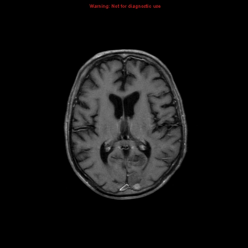 File:Cerebral and orbital tuberculomas (Radiopaedia 13308-13311 Axial T1 C+ 12).jpg