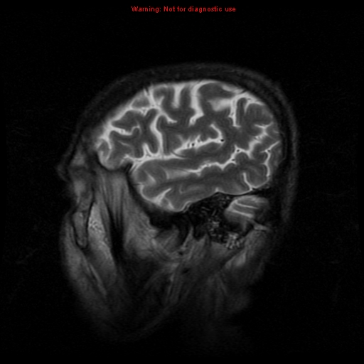 File:Cerebral and orbital tuberculomas (Radiopaedia 13308-13311 Sagittal T2 17).jpg