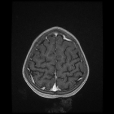 Cerebral and spinal tuberculosis (Radiopaedia 90489-107837 Axial T1 C+ 163).jpg