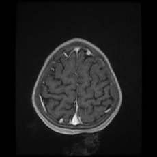 Cerebral and spinal tuberculosis (Radiopaedia 90489-107837 Axial T1 C+ 165).jpg