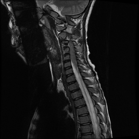 File:Cerebral and spinal tuberculosis (Radiopaedia 90489-107838 Sagittal 4).jpg