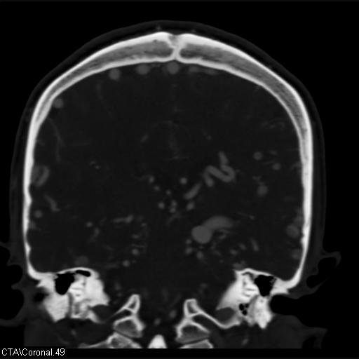 Cerebral arteriovenous malformation (Radiopaedia 28518-28759 C 49).jpg