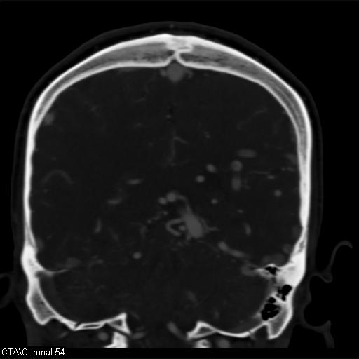 File:Cerebral arteriovenous malformation (Radiopaedia 28518-28759 C 54).jpg
