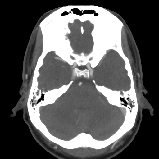 File:Cerebral arteriovenous malformation (Radiopaedia 39259-41505 AX CEREBRAL CTA 16).png