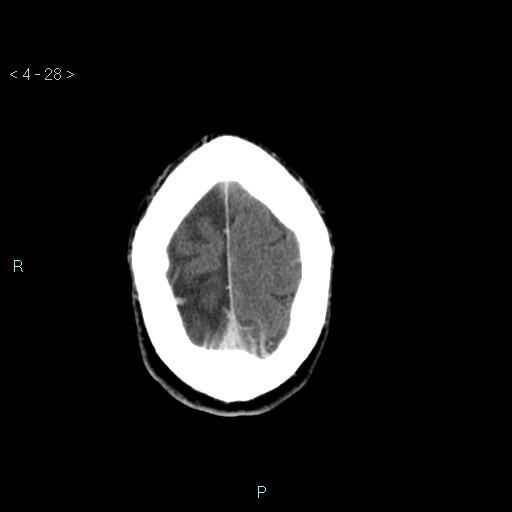 File:Cerebral arteriovenous malformation (Radiopaedia 40528-43125 Axial C+ delayed 28).jpg