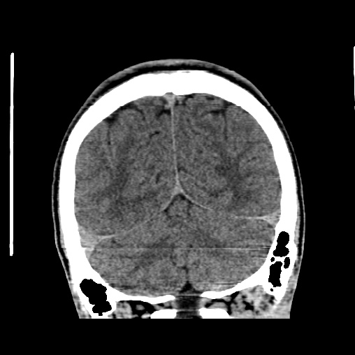 File:Cerebral arteriovenous malformation (Radiopaedia 61964-70028 Coronal non-contrast 48).jpg