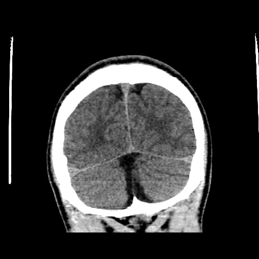 Cerebral arteriovenous malformation (Radiopaedia 61964-70028 Coronal non-contrast 52).jpg