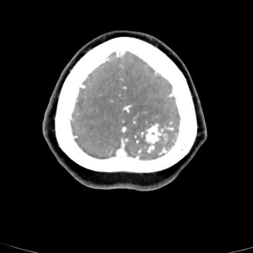 Cerebral arteriovenous malformation (Radiopaedia 73830-84645 B 13).jpg