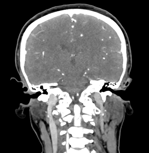 Cerebral arteriovenous malformation (Radiopaedia 73830-84645 C 57).jpg