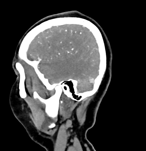 Cerebral arteriovenous malformation (Radiopaedia 73830-84645 D 76).jpg