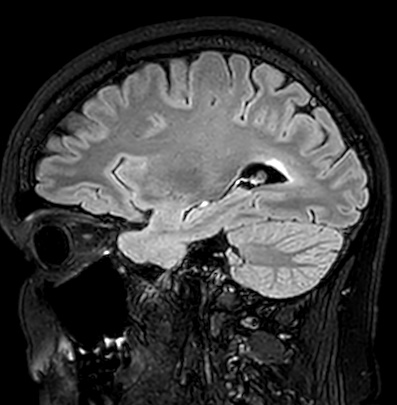 Cerebral arteriovenous malformation (Radiopaedia 74411-85746 Sagittal FLAIR 34).jpg