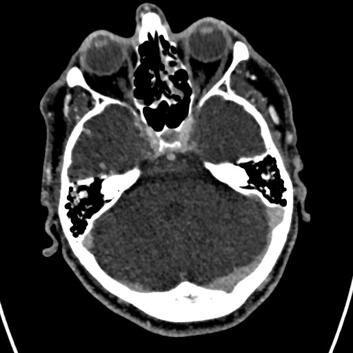 Cerebral arteriovenous malformation (Radiopaedia 78188-90746 Axial C+ delayed 49).jpg