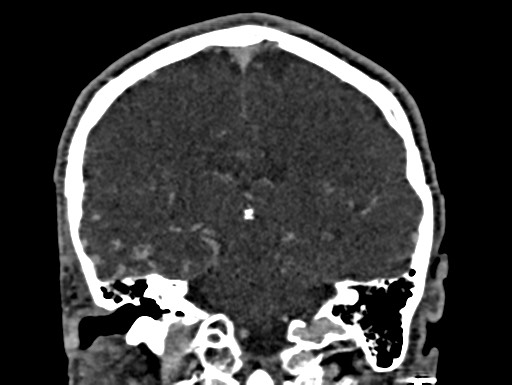 Cerebral arteriovenous malformation (Radiopaedia 78188-90746 Coronal C+ delayed 72).jpg