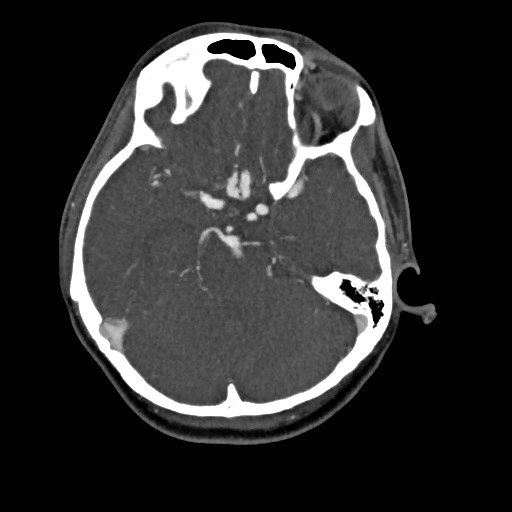 File:Cerebral arteriovenous malformation (Radiopaedia 79677-92888 A 15).jpg