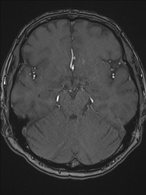 File:Cerebral arteriovenous malformation (Radiopaedia 84015-99245 Axial TOF 103).jpg