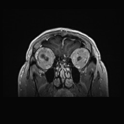 Cerebral arteriovenous malformation (Radiopaedia 84015-99245 Coronal T1 C+ 28).jpg