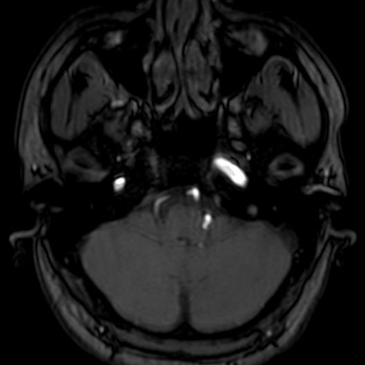 Cerebral arteriovenous malformation at posterior body of corpus callosum (Radiopaedia 74111-84925 Axial MRA 29).jpg
