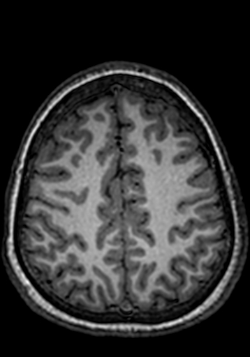 Cerebral arteriovenous malformation at posterior body of corpus callosum (Radiopaedia 74111-84925 Axial T1 65).jpg