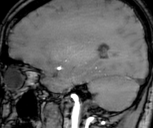 Cerebral arteriovenous malformation at posterior body of corpus callosum (Radiopaedia 74111-84925 J 277).jpg