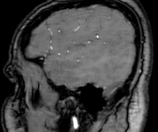Cerebral arteriovenous malformation at posterior body of corpus callosum (Radiopaedia 74111-84925 J 40).jpg