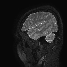 Cerebral arteriovenous malformation at posterior body of corpus callosum (Radiopaedia 74111-84925 Sagittal T2 15).jpg