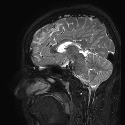 Cerebral arteriovenous malformation at posterior body of corpus callosum (Radiopaedia 74111-84925 Sagittal T2 70).jpg
