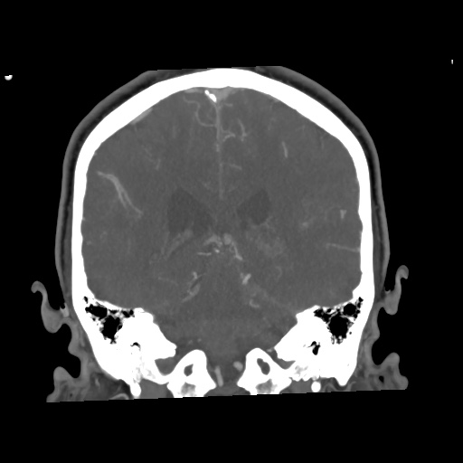 Cerebral arteriovenous malformation with lobar hemorrhage (Radiopaedia 35598-57216 C 59).jpg