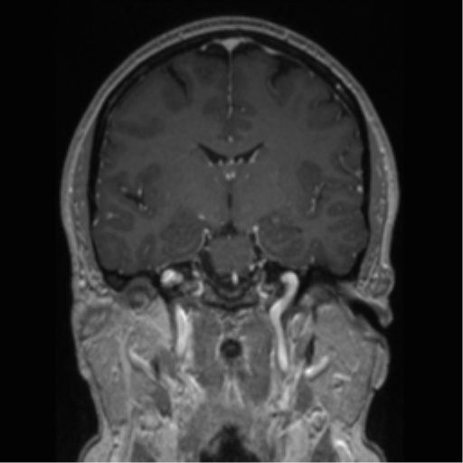 Cerebral cavernoma and development venous anomaly (Radiopaedia 37603-39482 Coronal T1 C+ 51).png