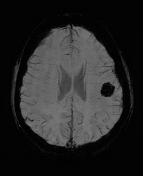 Cerebral cavernous venous malformation (Radiopaedia 70008-80021 Axial SWI 47).jpg